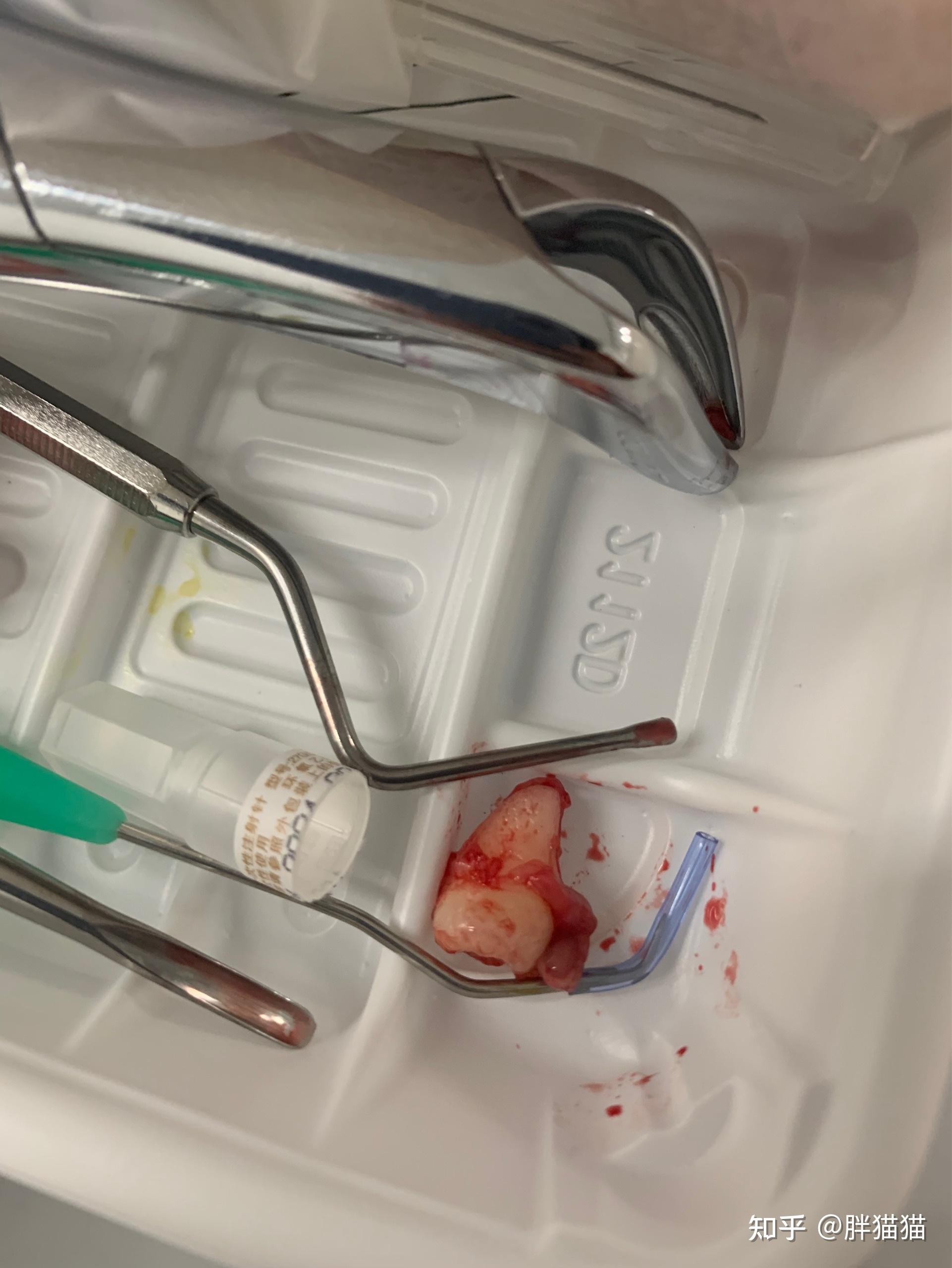 15分钟73智齿拔除的体验