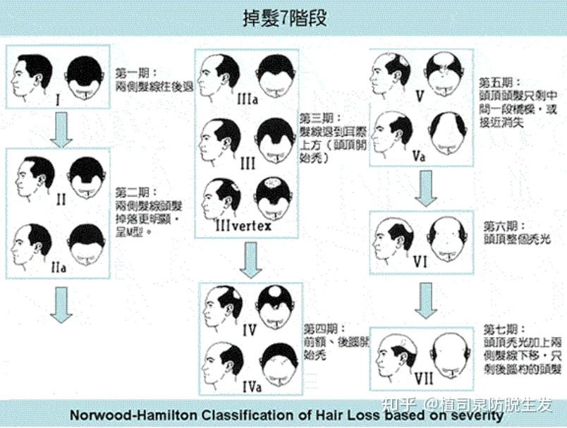 那么借来给大家讲一下如何判断自己属于几级脱发呢?