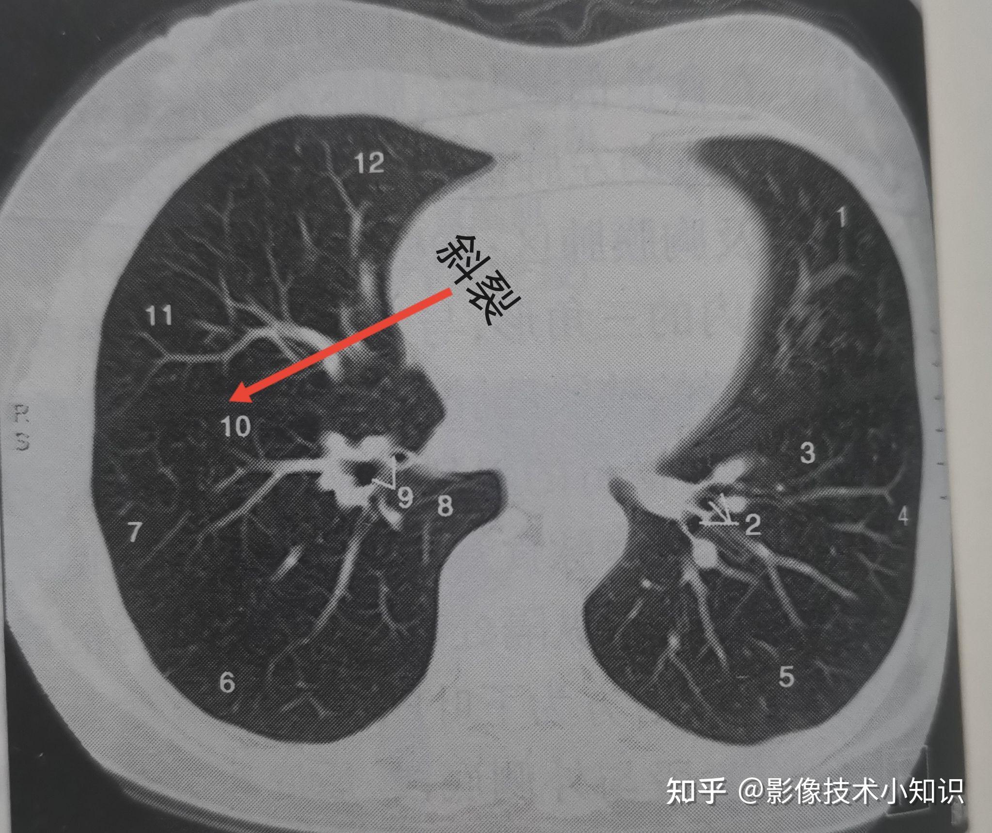 怎么在CT上识别肺的分段和支气管 - 知乎