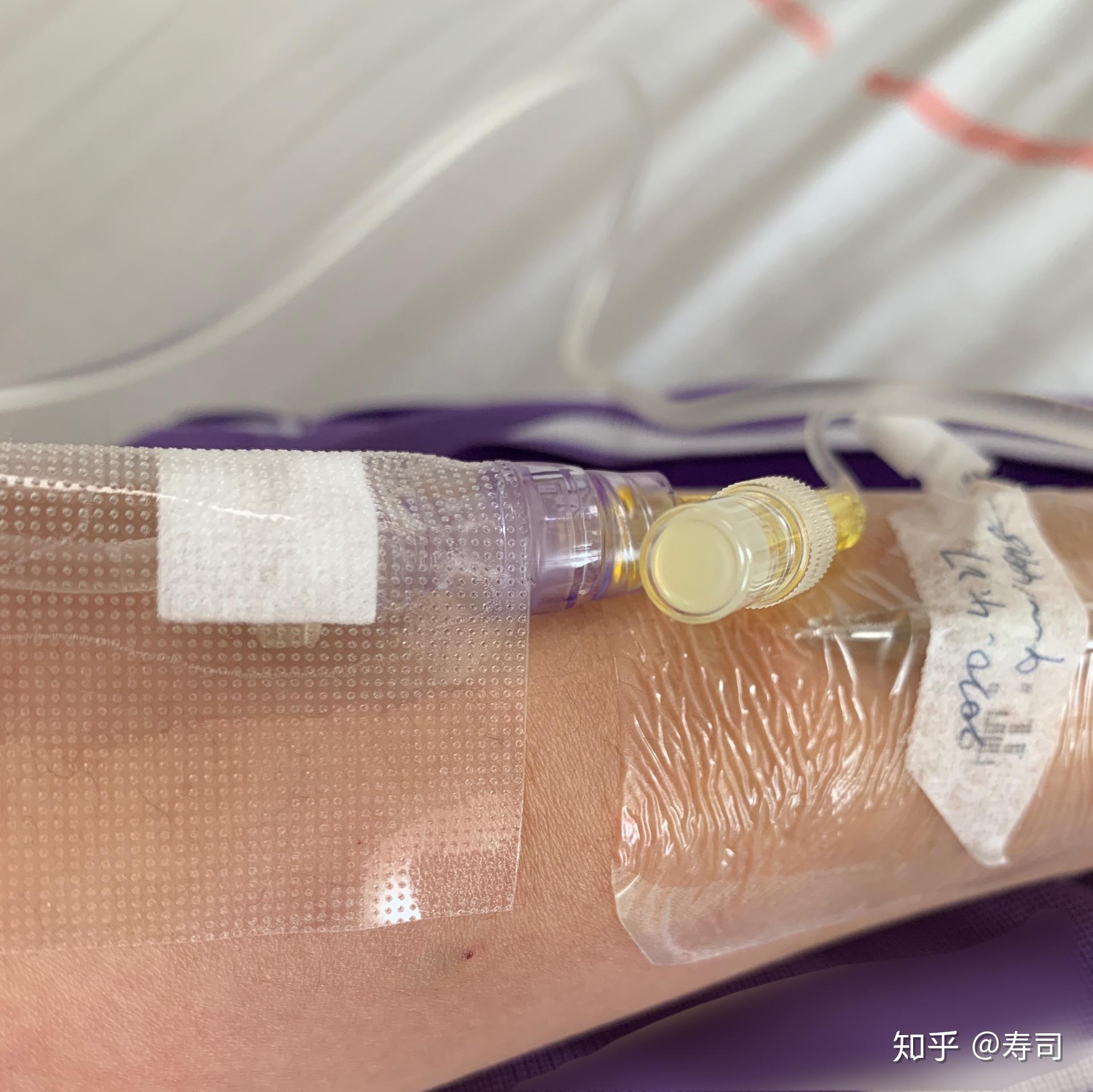 我的肺结核确诊和治疗经历