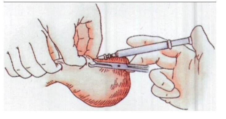 男性结扎的副作用和危害其实很多一定要慎重