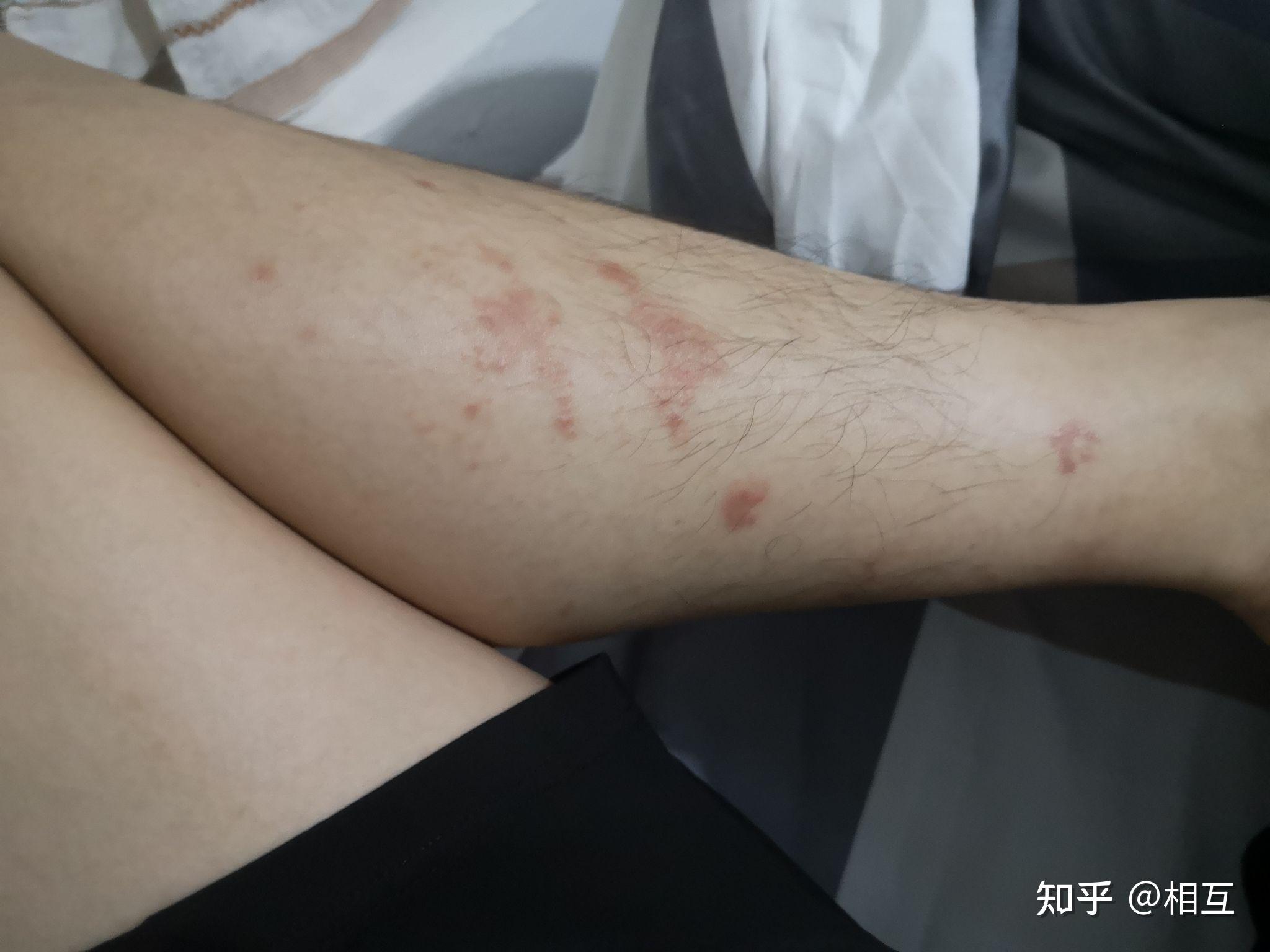 有没有疥疮治好的小伙伴 - 知乎
