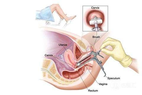 宫颈活检过程步骤图片
