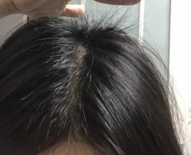 大块掉头皮屑有什么好用的去屑洗发水推荐