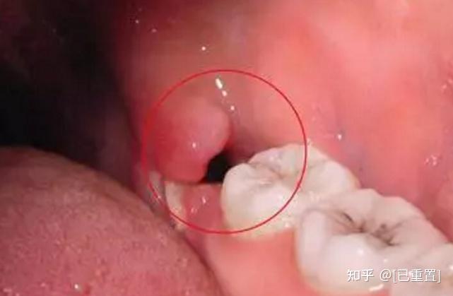 不让您漱口是怕把您把凝血块一起吐了出来,因此,从拔智齿开始,到拔完