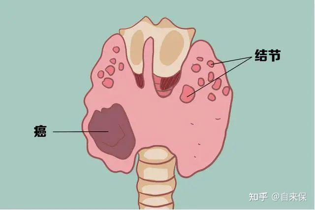 得了甲状腺结节怎么买保险内含百万医疗险重疾险寿险和意外险看完这篇