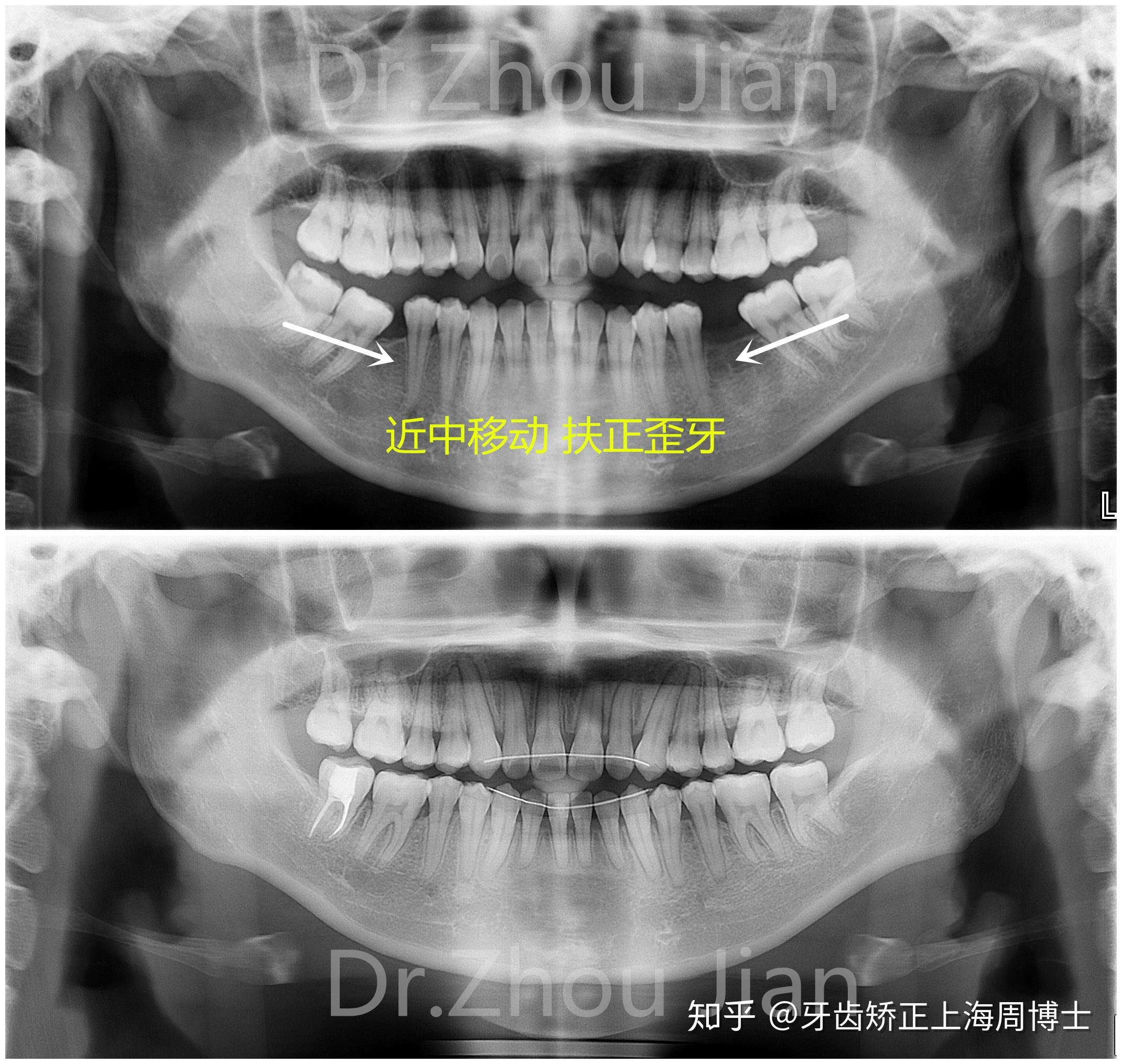 北京牙齿矫正丨正畸治疗中为什么需要使用支抗钉（骨钉）？ - 知乎