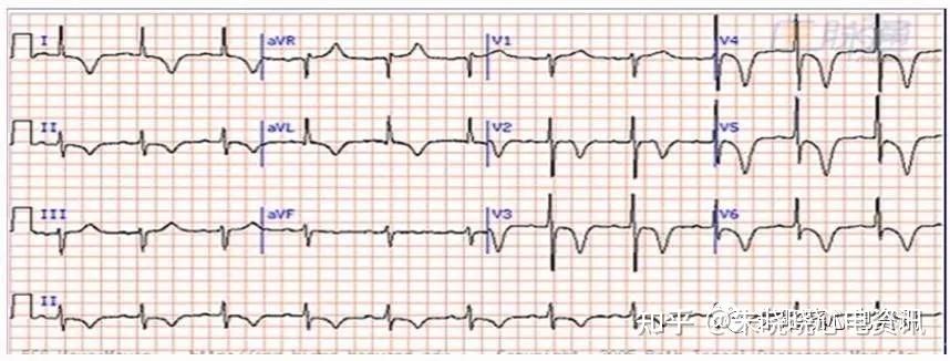 心尖肥厚型心肌病心电图改变 - 知乎