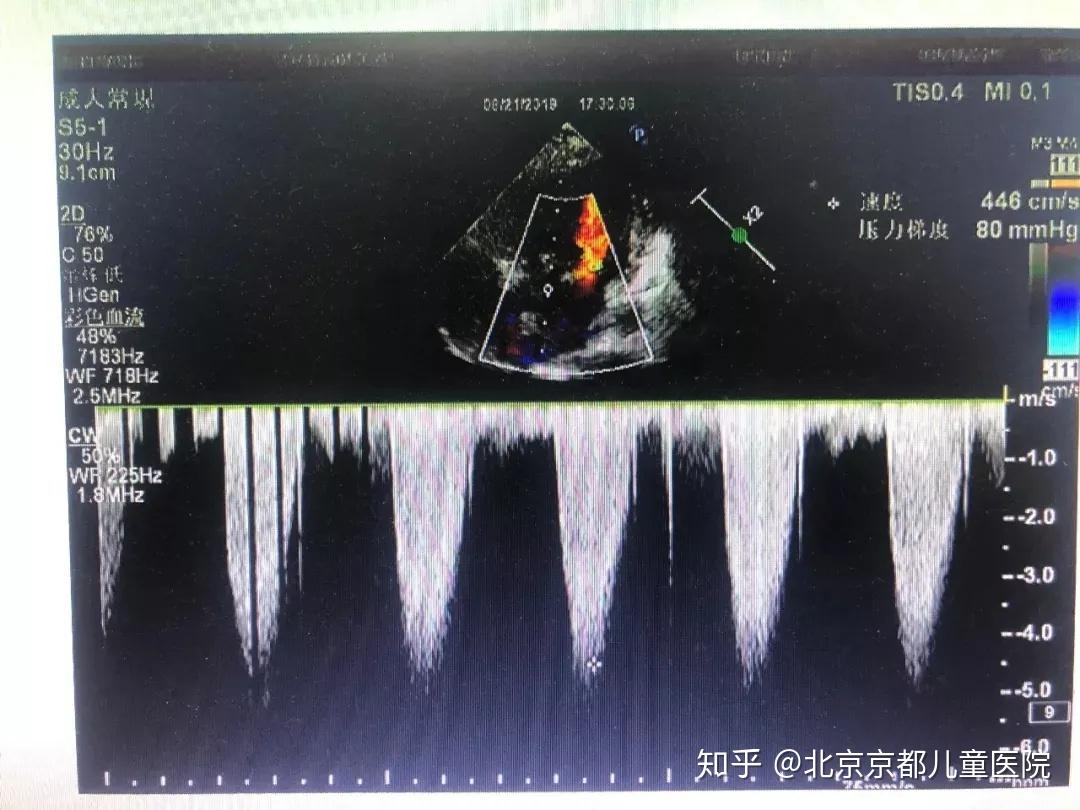 重度主动脉瓣功能二叶畸形并狭窄的低龄患儿在我科成功被救治