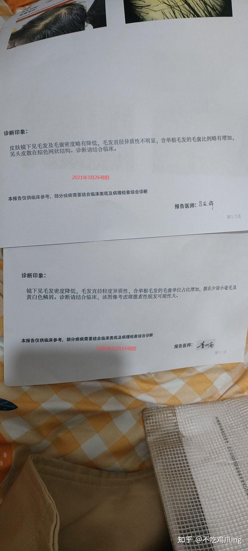 女生脂溢性脱发治疗过程记录2