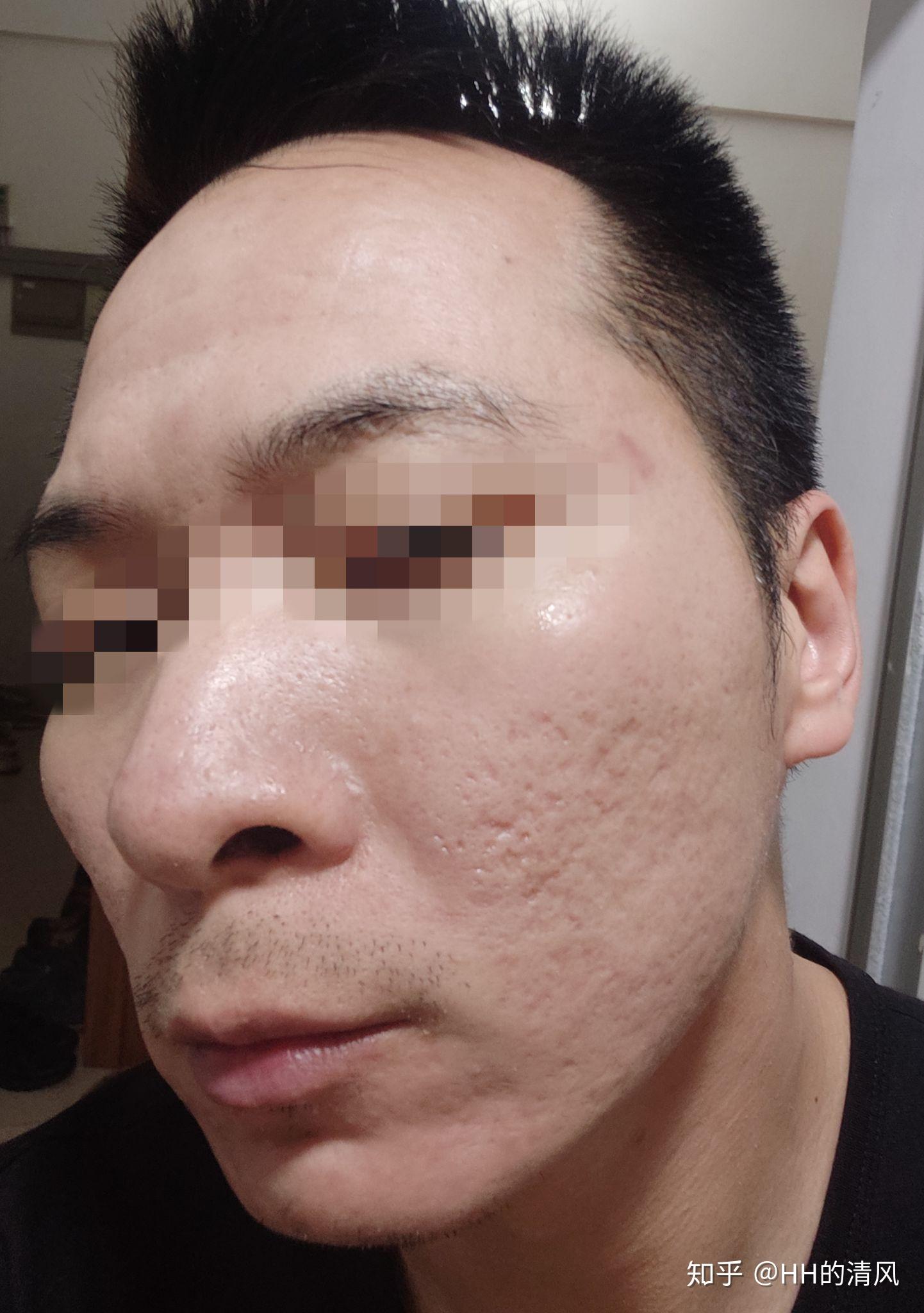 6月24日更新第二次记录剥脱性点阵激光祛痘坑3月8日做了第一次