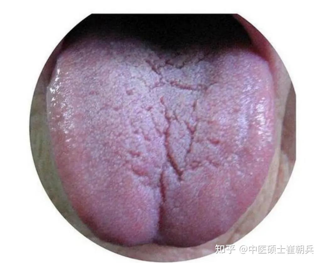 正常人的舌头红点图片,梅毒舌头早期症状图片 - 伤感说说吧