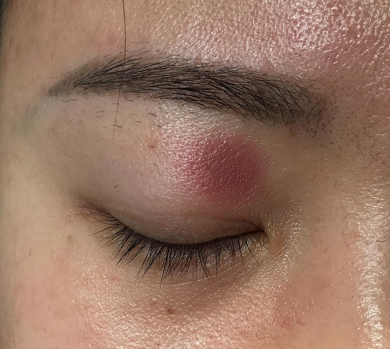 以为眼睛上的皮疹是神经性皮炎看了医生才知道是药物过敏