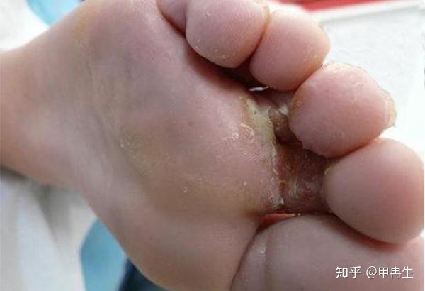 为什么脚会出汗怎么回事百科在线