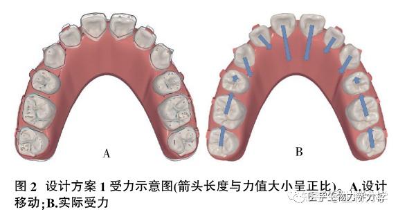 拔牙病例隐形矫治器设计的有限元分析 - 知乎