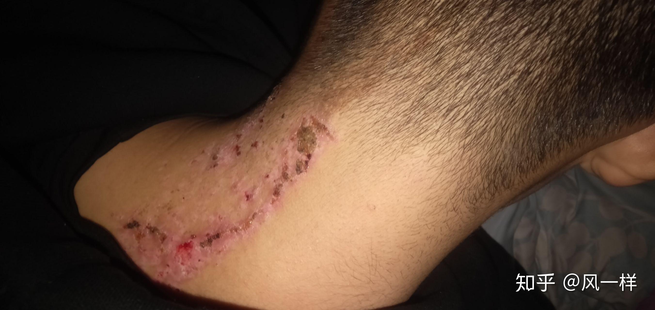 激光祛痣手术留疤怎么弄用什么药膏可以恢复