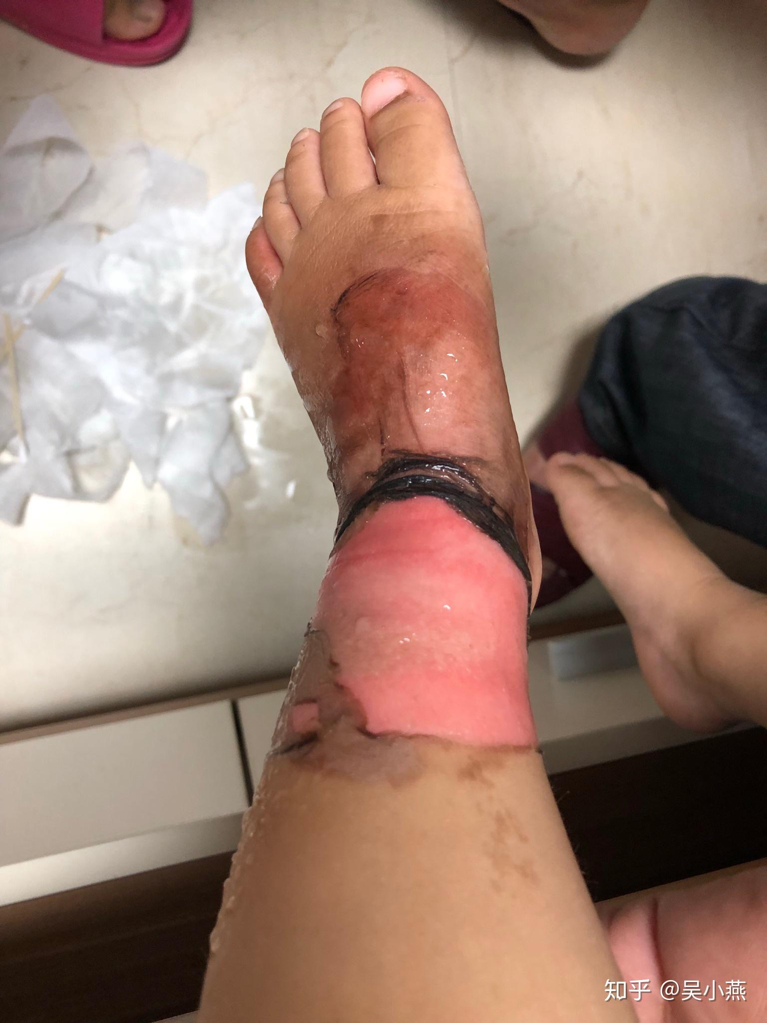 小孩二度烫伤治疗与护理记录