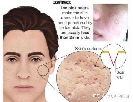 脸上的痘印怎么消除?这份科学去痘印指南给你安排明白了! - 知乎