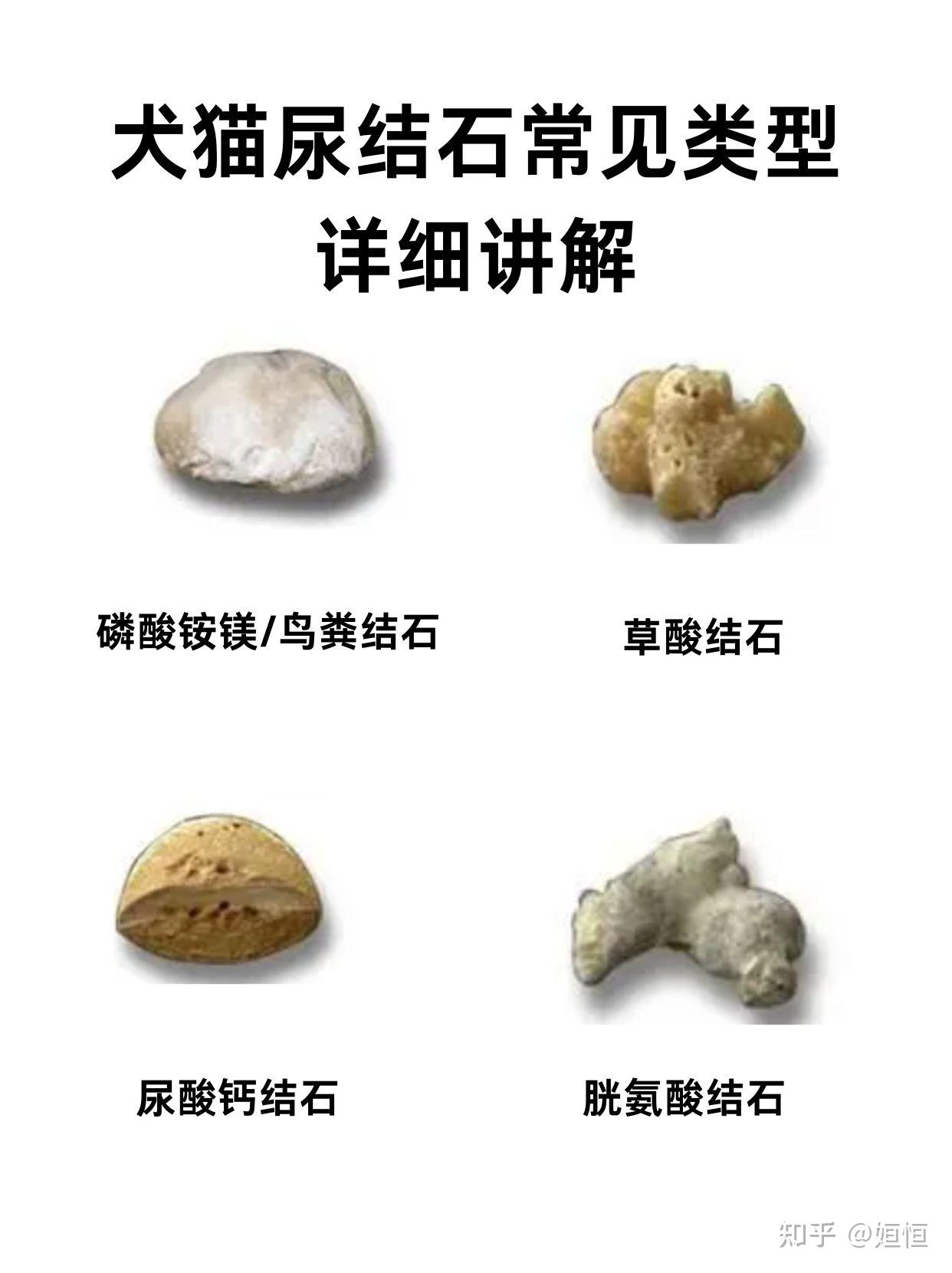 虽然统称为结石,但是结石的成分和种类也是不同的:1.