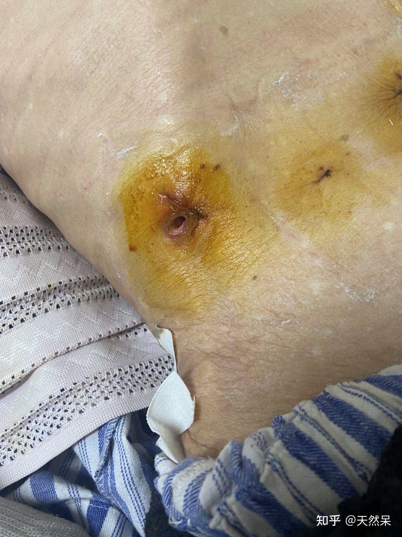 胃手术的伤口照片图片