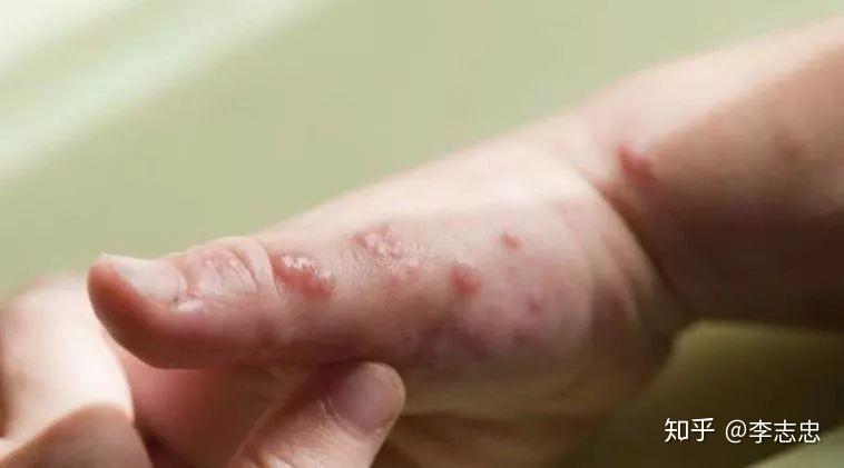每年夏天手指长水泡又特别痒八成是汗疱疹来袭