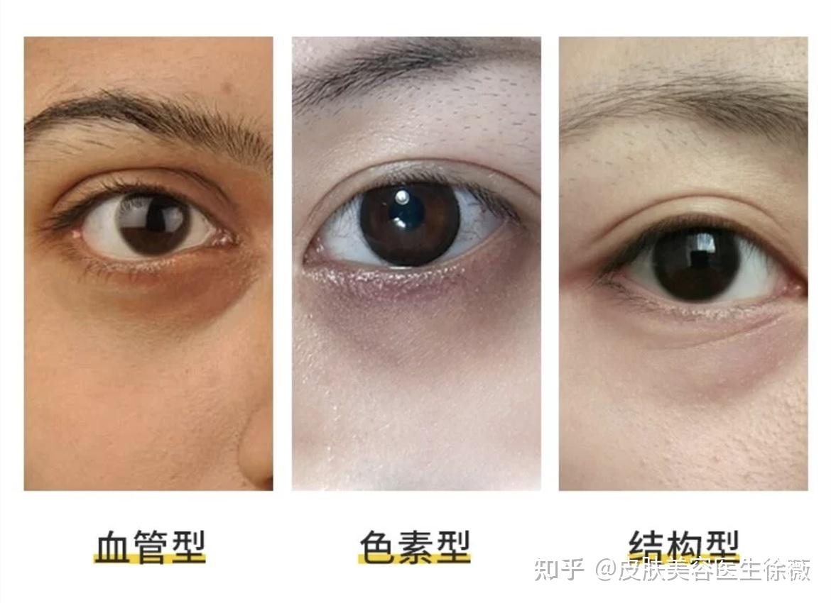 熬夜才会有熊猫眼?你太天真了