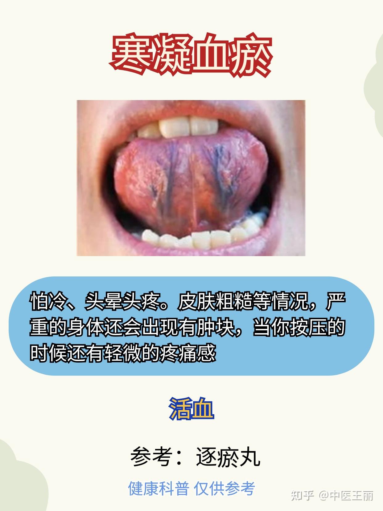 舌下青筋又粗又黑?血瘀很严重? - 知乎