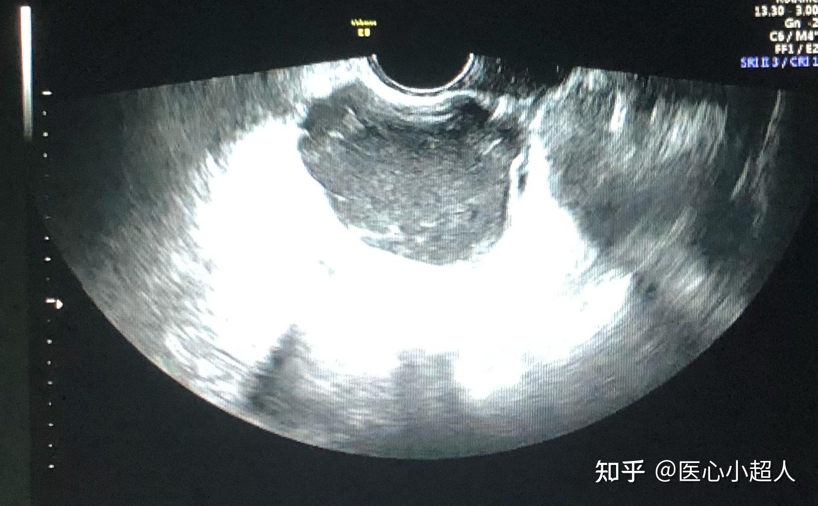 病例6-44 卵巢非赘生性囊肿(3)-超声读片-医学