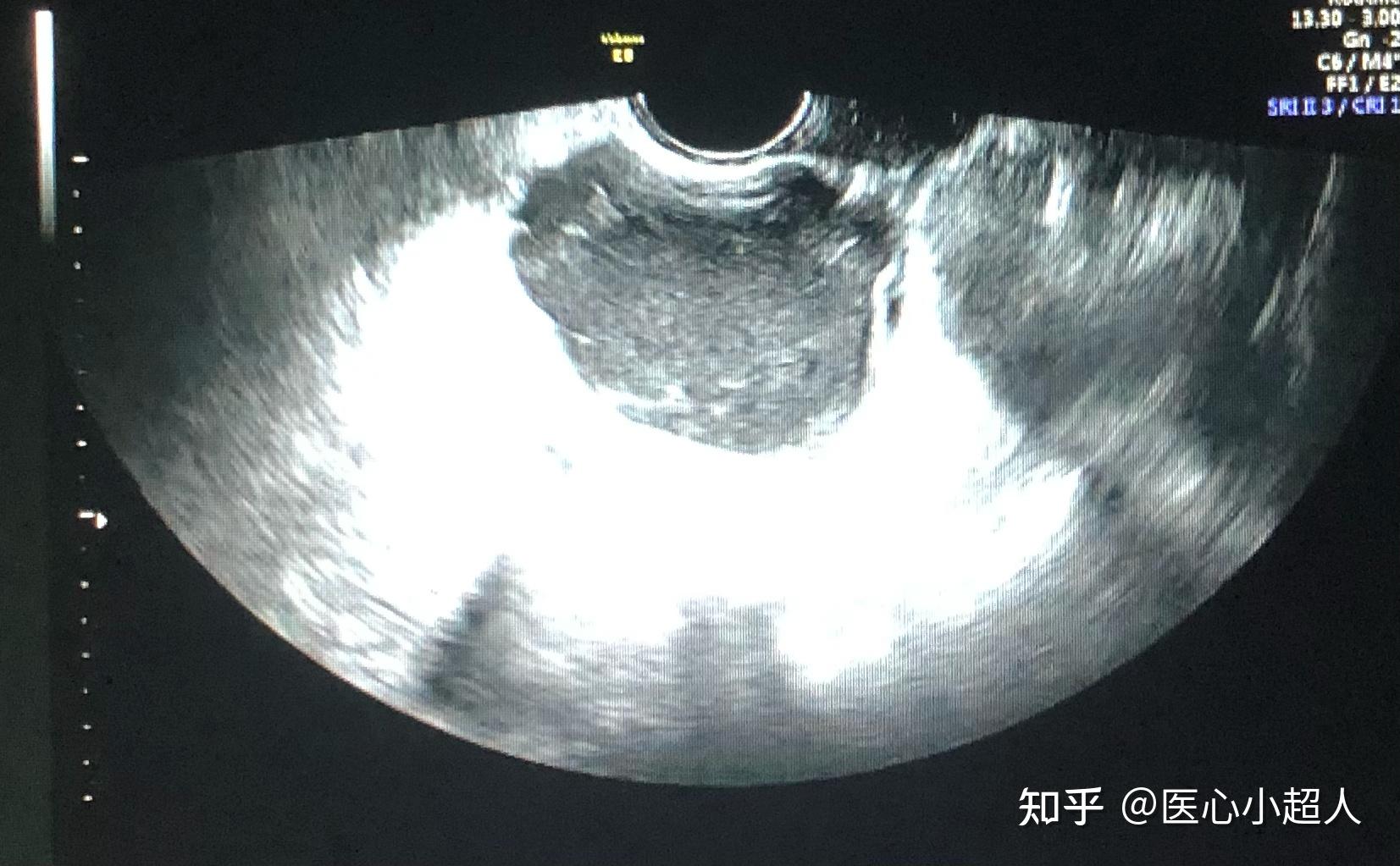 卵巢子宮內膜異位囊腫巧克力囊腫