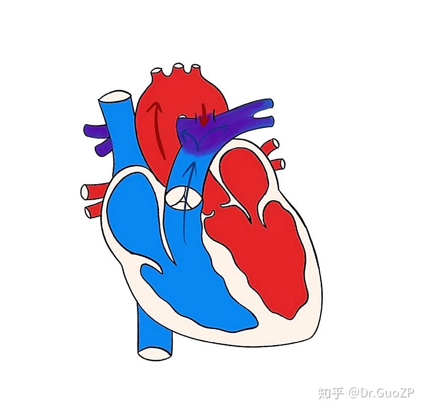 聊聊先天性心脏病动脉导管未闭