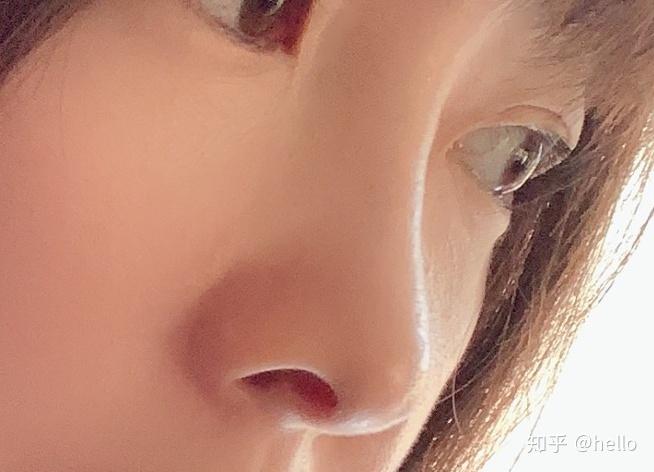 亲身体验鼻翼缘退缩矫正手术