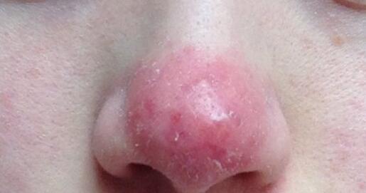 粉刺脓包型痤疮治疗 v2-996767fa3cfd47489818d114a0fd5b74_1440w.jpg?source=172ae18b