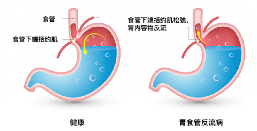 胃食管反流停药就复发，该怎么做？ - 知乎
