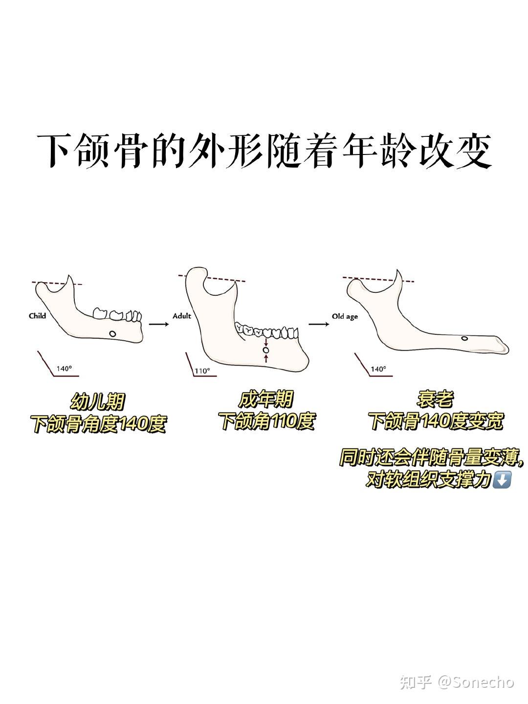 牙齒矯正,凸面型,低角,深覆合,骨性ii類,安氏ii類二分類(2021.