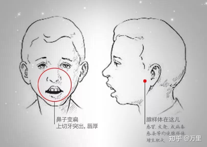 定投第376天簡單科普下腺樣體面容