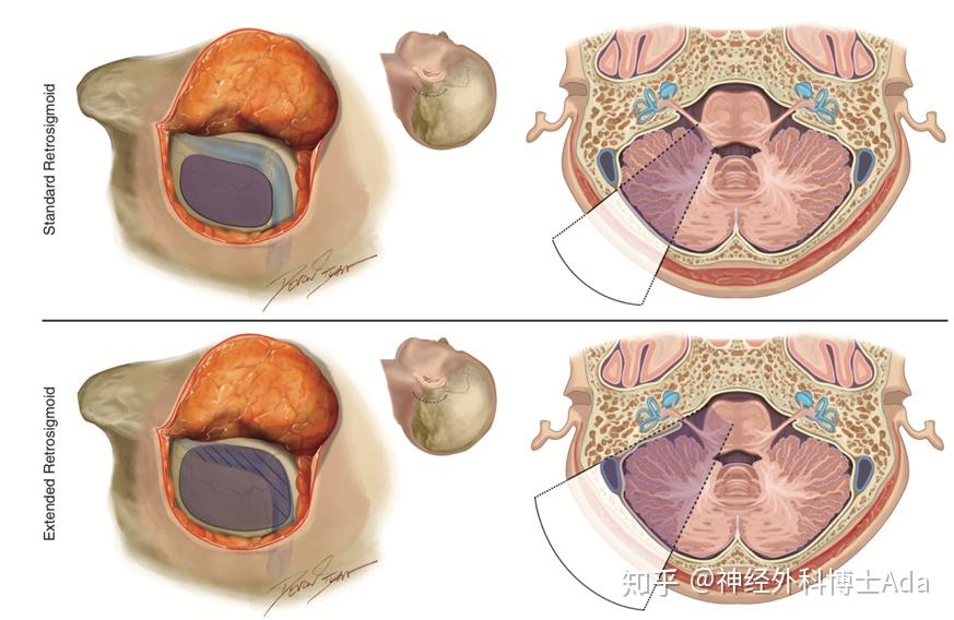 腦瘤開顱手術入路解讀標準乙狀竇後入路vs擴大乙狀竇後入路開顱術