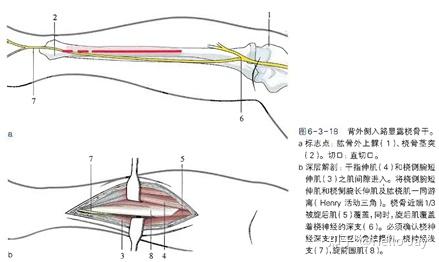 固定尺桡骨双骨折一般用双切口,尝试用单切口将增加神经损伤和尺桡骨