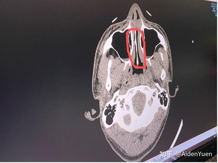 鼻中隔偏曲手术经历