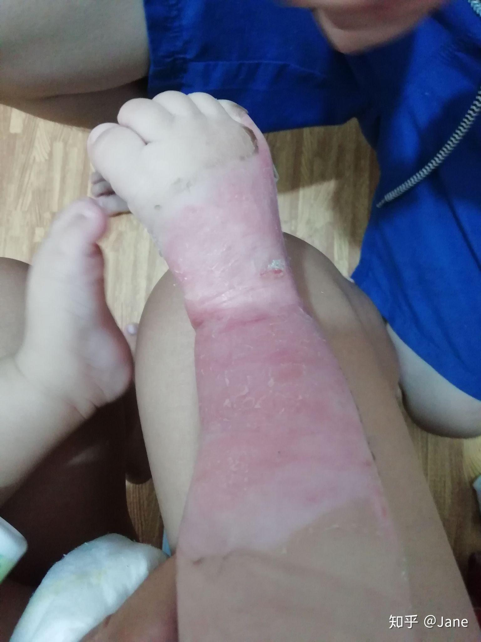 宝宝烫伤恢复到祛疤过程记录