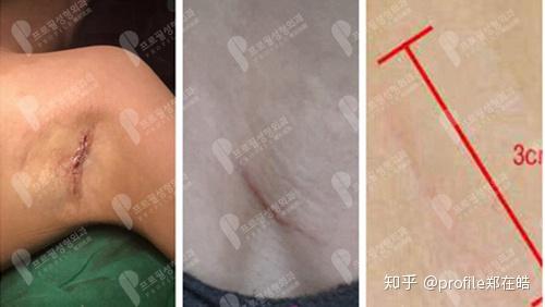假体隆胸切口明显吗术后会不会留疤