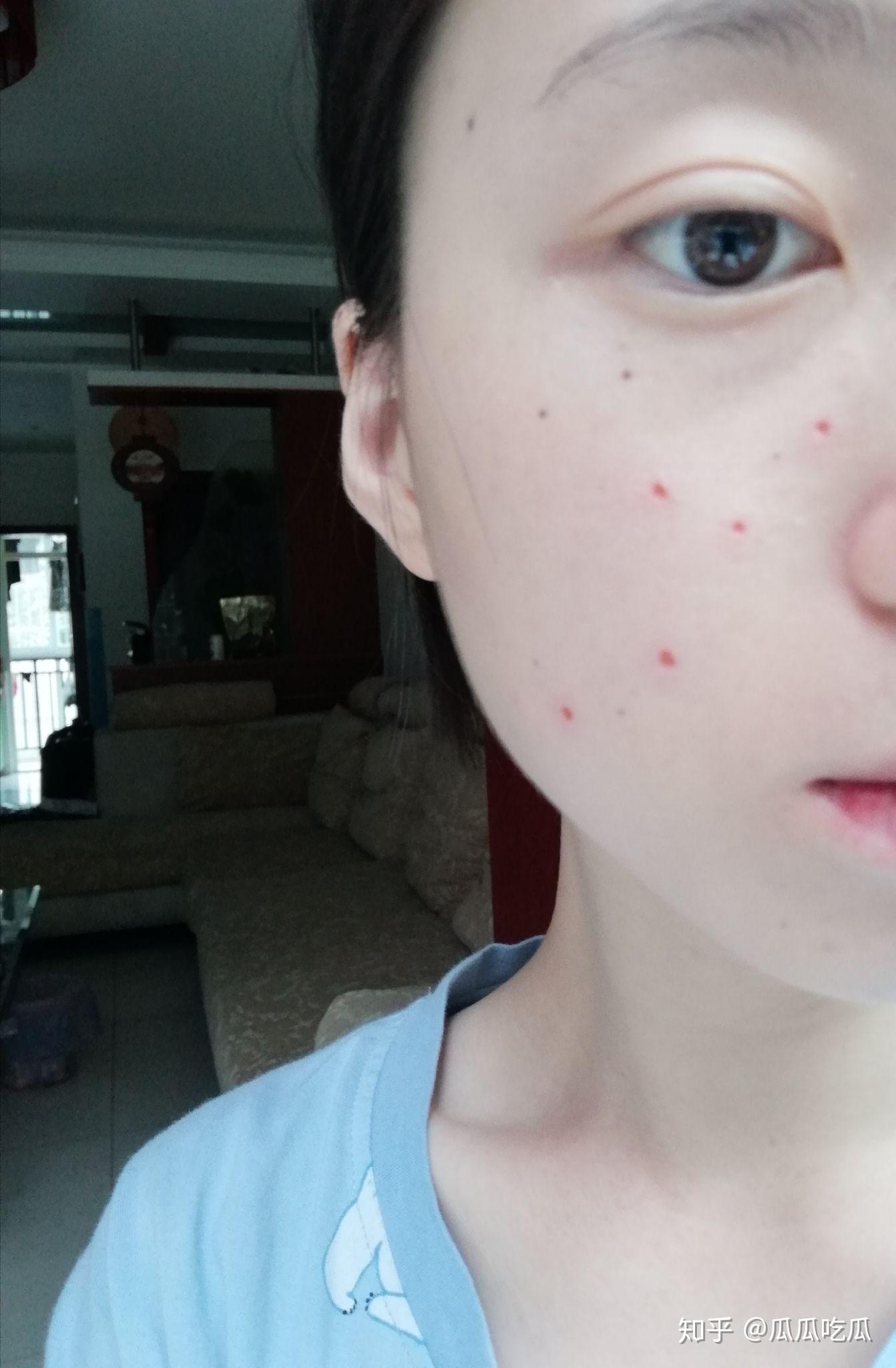 双生痣是什么样的 v2-99b0916f7b91e96b89ee449ac665cc03_r.jpg