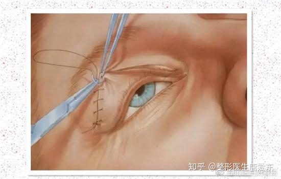 全切双眼皮过程之缝合