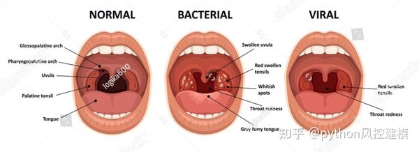 一图读懂慢性咽喉炎Chronic pharyngitis - 知乎