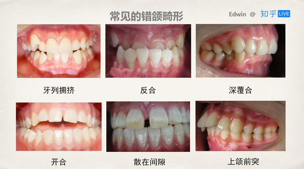 如何从小到大保护好牙齿?