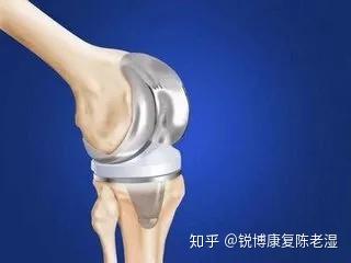换了人工膝盖就能一切照旧 聊聊膝关节置换的那些事 知乎