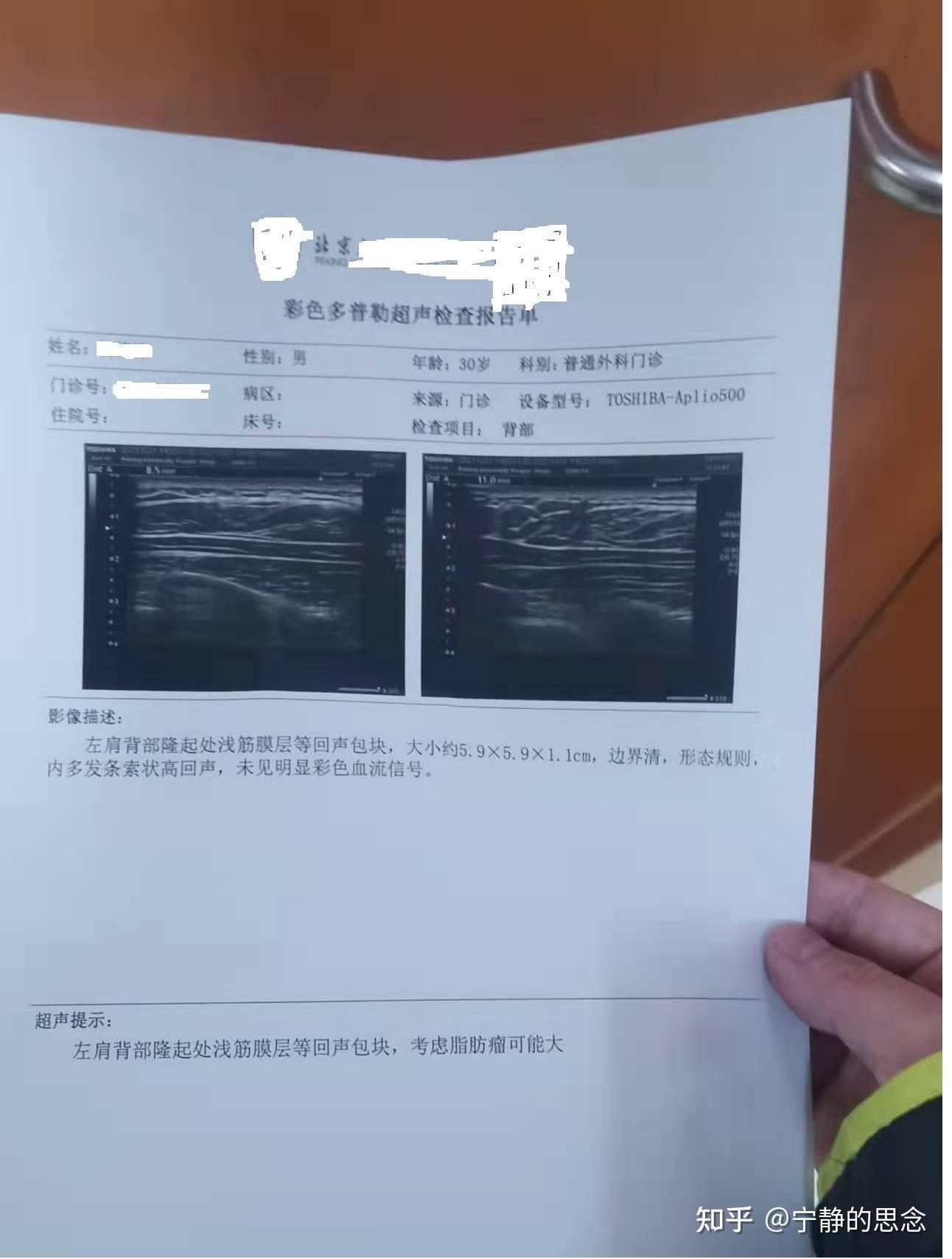我首先在北京某医院做了彩超,初步结论是脂肪瘤可能性大,并得到了大小