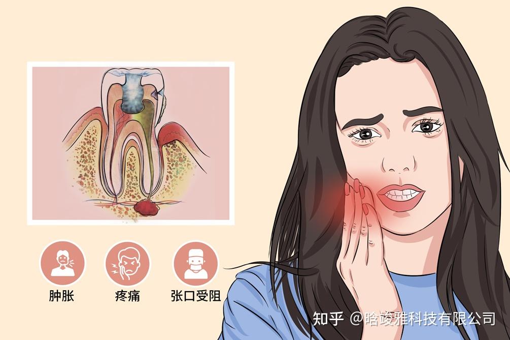 智齿冠周炎处理方法 - 知乎