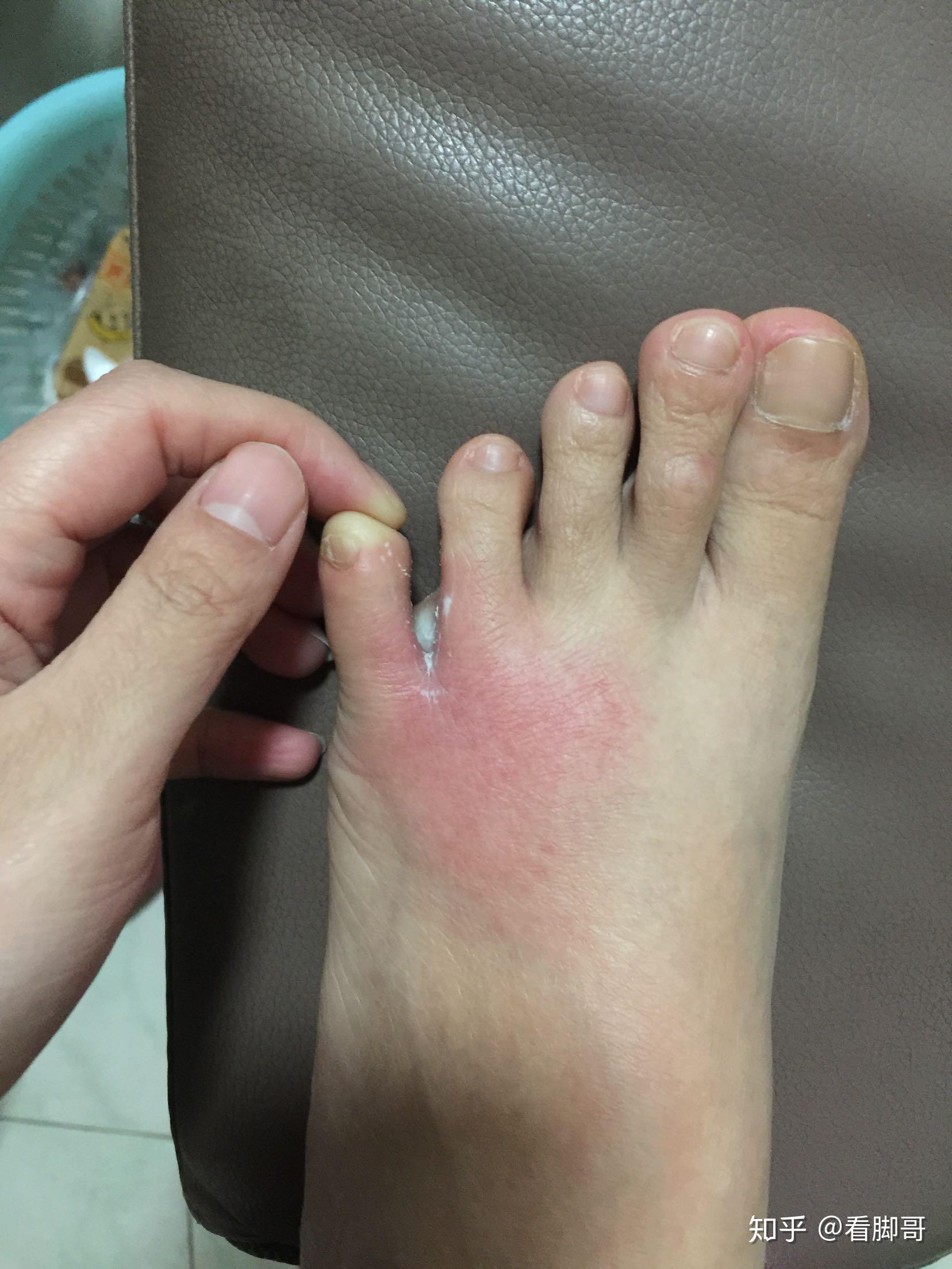 用热水烫有脚气的脚为何如此舒服