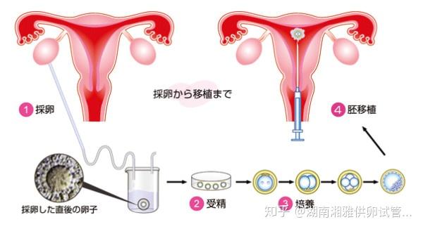 人工授精or试管婴儿 代孕应该如何选择 知乎