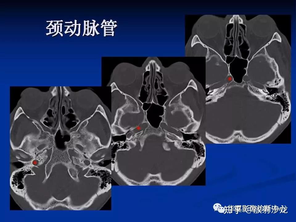 实用,详细的颅底各孔道影像解剖! 